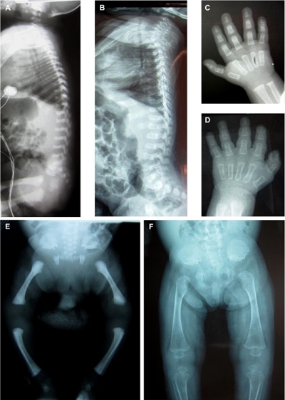 A genetic mutation has been linked to a fatal skeletal abnormality ...