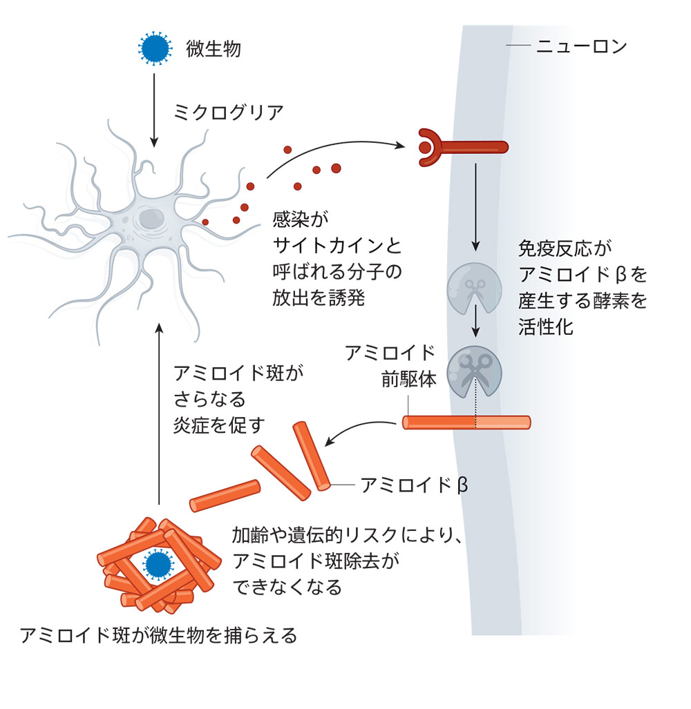 アルツハイマー病の原因